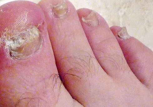 ciuperca unghiilor de la picioare