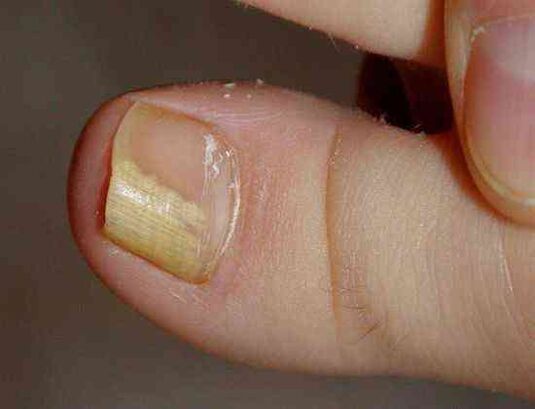 formă laterală distală de ciupercă a unghiilor
