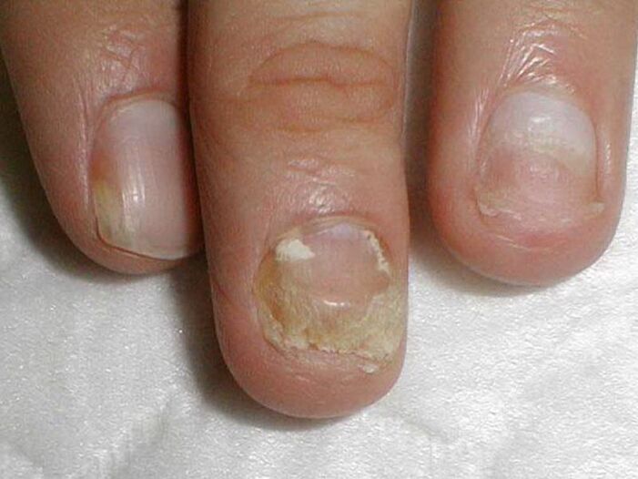 tratament candida ciuperca unghiilor