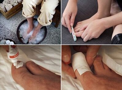 Aburirea picioarelor și aplicarea cremei de uree pe unghiile afectate de ciuperci