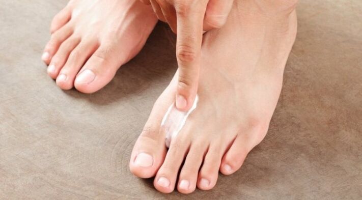 cum și cum să tratezi ciuperca între degetele de la picioare