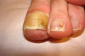 ciuperca neglijata a unghiilor de la picioare