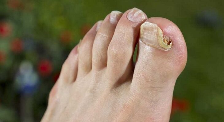 deteriorarea plăcii unghiei cu ciupercă pe picioare