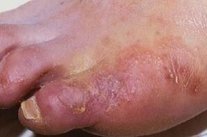 manifestări ale unei infecții fungice pe pielea picioarelor