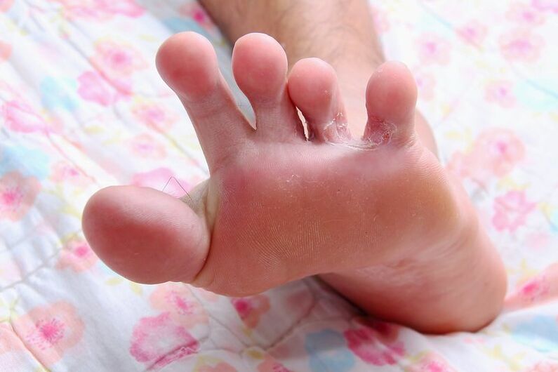ciuperca dintre degetele de la picioare fotografia 2