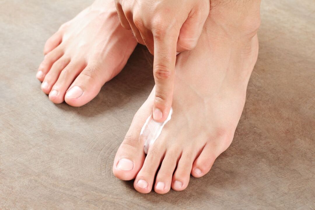 tratamentul ciupercilor de pe picioare cu unguent