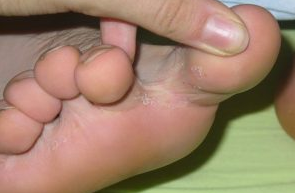 Ciuperca dintre degetele de la picioare