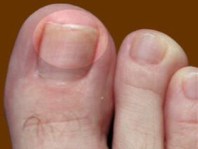 Ciuperca unghiilor de la picioare - o indicație pentru utilizarea picăturilor fungicide