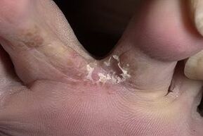 ciuperca pielii dintre degetele de la picioare