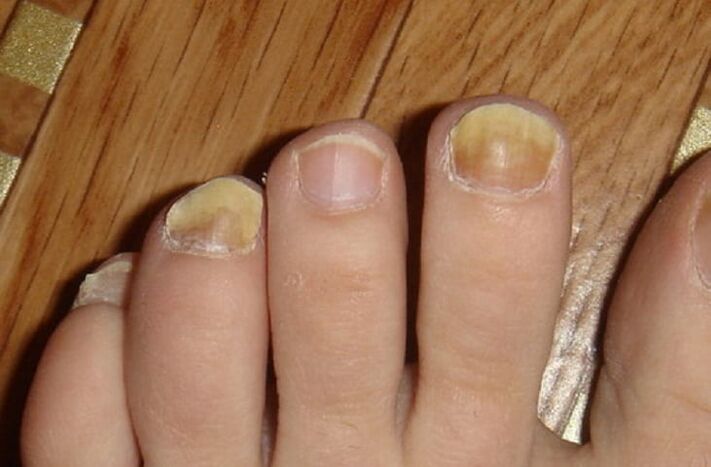 simptome de ciupercă pe unghii și pielea picioarelor