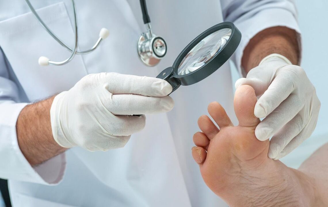 medicul examinează picioarele cu ciupercă
