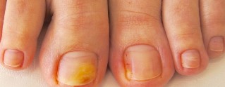 ciuperca unghiilor de la picioare simptome