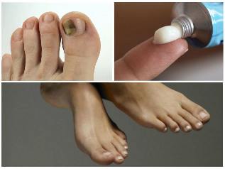 ciuperca unghiilor de la picioare tratament