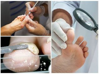ciuperca de piele de la picioare diagnostic