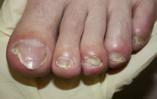 simptomele ciuperca unghiilor