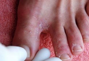 fisurile dintre degetele de la picioare provoacă tratament